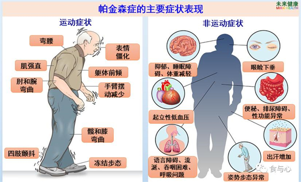 帕金森2.jpg